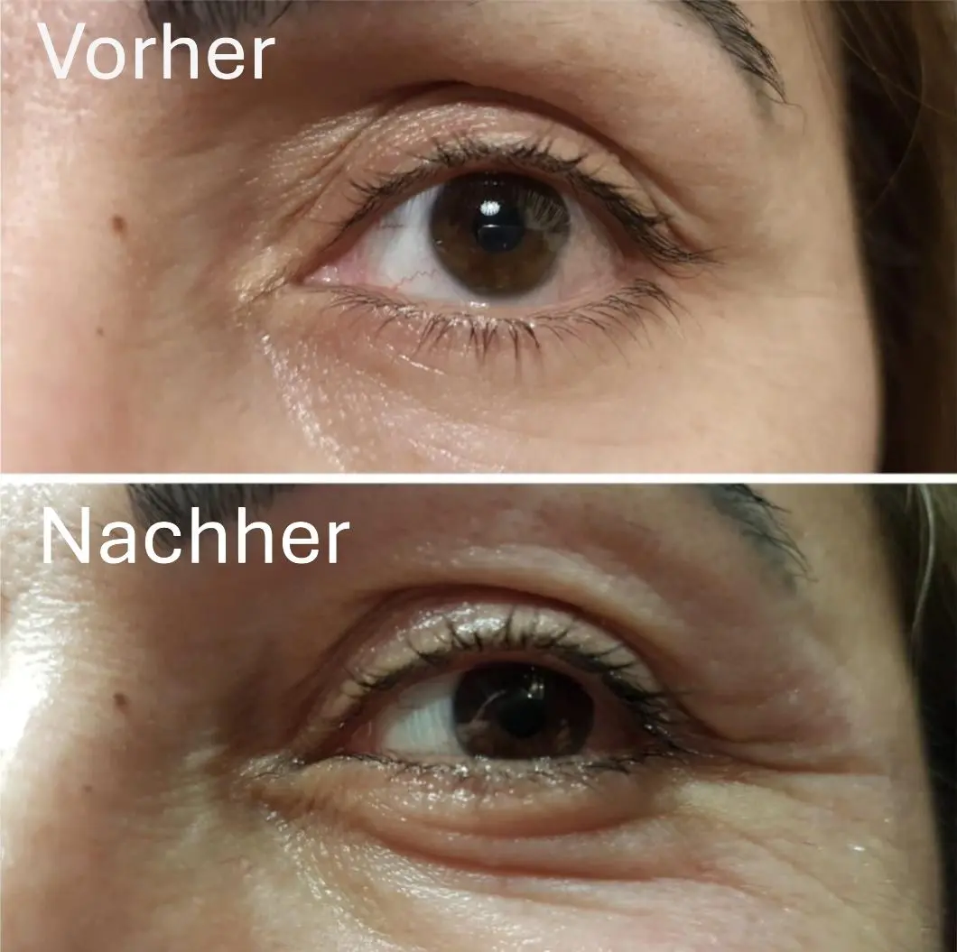 plasmaPen_vorherNachher_06